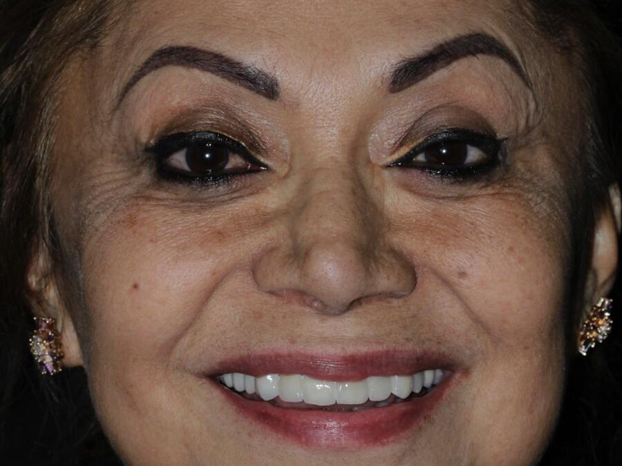 Diseño de sonrisa, caso real de SANI — Después