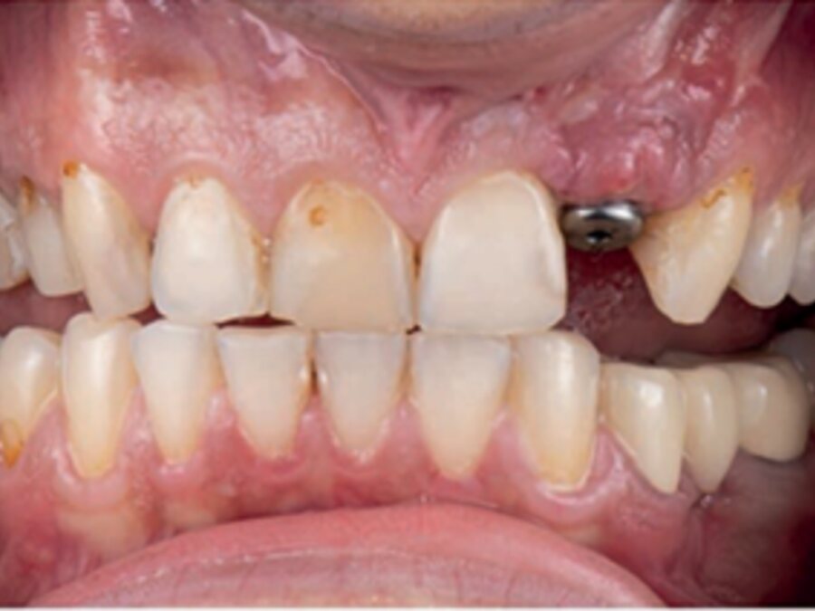 Implantes dentales — Antes