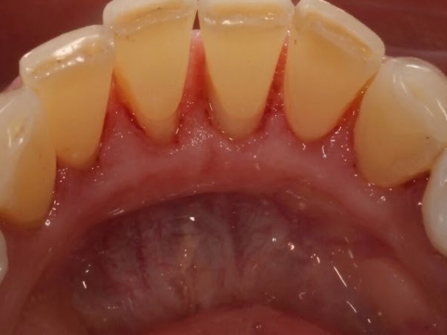 Limpieza dental
